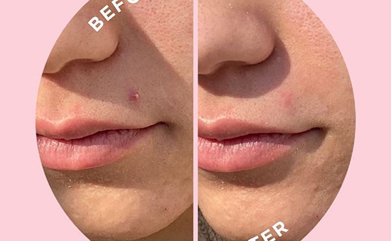 microneedle Acne patch